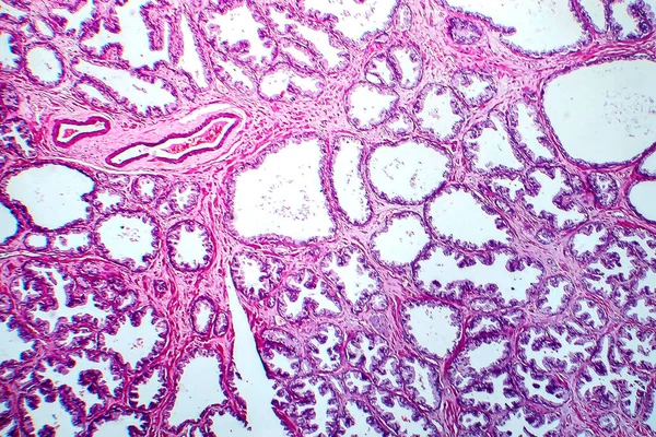 Prostaatkanker Lichtmicrograaf Foto Onder Microscoop — Stockfoto