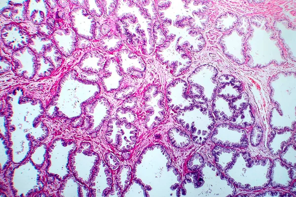 Prostatacancer Ljusmikrograf Foto Mikroskop — Stockfoto