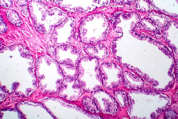 Cáncer Próstata Micrografía Ligera Foto Bajo Microscopio —  Fotos de Stock
