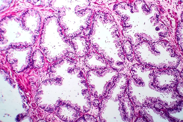 Cancro Alla Prostata Microscopio Leggero Foto Microscopio — Foto Stock