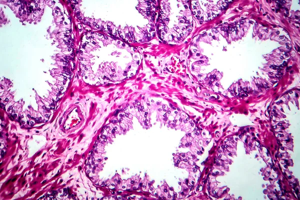 前列腺癌 显微镜下照片 — 图库照片