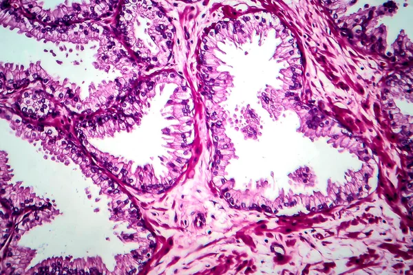 Cáncer Próstata Micrografía Ligera Foto Bajo Microscopio —  Fotos de Stock