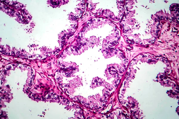 Καρκίνος Του Προστάτη Μικρογραφία Φωτός Φωτογραφία Στο Μικροσκόπιο — Φωτογραφία Αρχείου