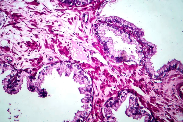 前立腺癌 光マイクログラフ 顕微鏡下の写真 — ストック写真