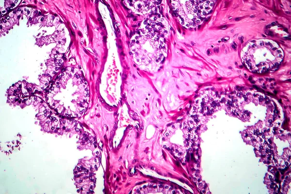 前列腺癌 显微镜下照片 — 图库照片