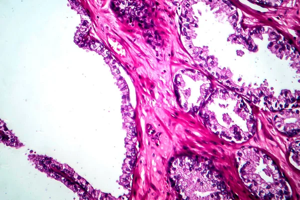 Rak Gruczołu Krokowego Mikrograf Światła Zdjęcie Pod Mikroskopem — Zdjęcie stockowe