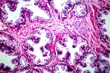 Prostat kanseri, ışık mikrografı, mikroskop altında fotoğraf.