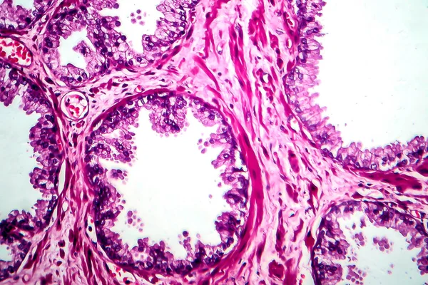 Cáncer Próstata Micrografía Ligera Foto Bajo Microscopio — Foto de Stock