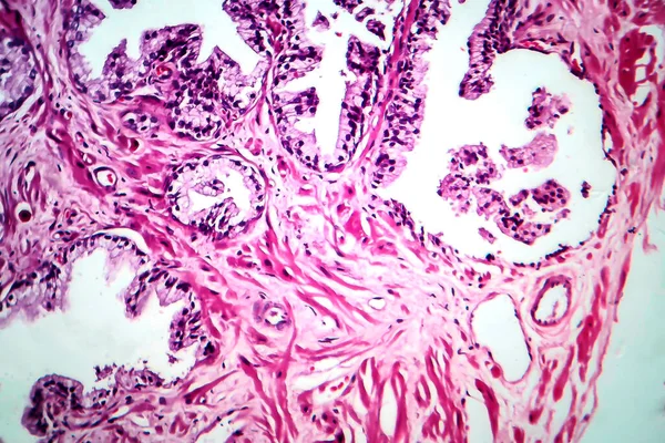 Cancro Alla Prostata Microscopio Leggero Foto Microscopio — Foto Stock