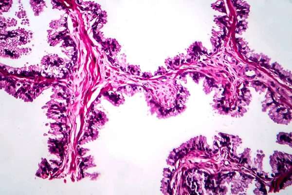 Prostatakrebs Lichtmikroskopie Foto Unter Dem Mikroskop — Stockfoto