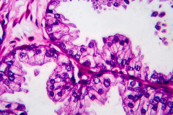 Cáncer Próstata Micrografía Ligera Foto Bajo Microscopio — Foto de Stock