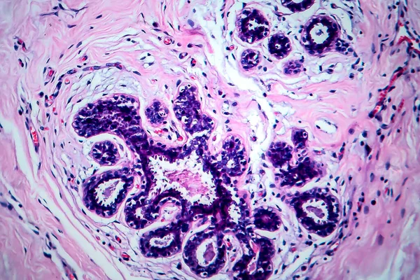 Καρκίνος Του Μαστού Μικρογραφία Φωτός Φωτογραφία Στο Μικροσκόπιο — Φωτογραφία Αρχείου