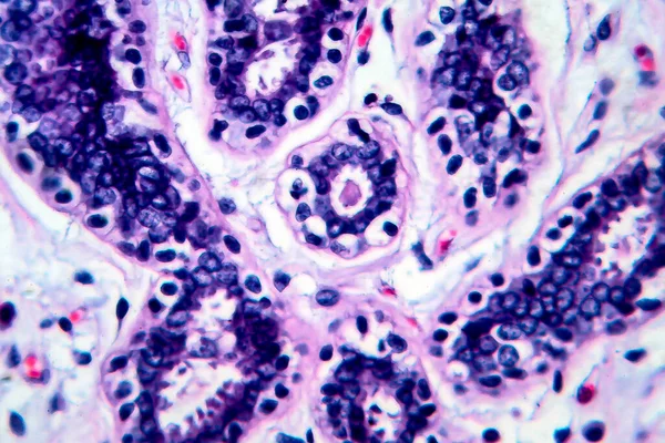 Brustkrebs Lichtmikroskopie Foto Unter Dem Mikroskop — Stockfoto