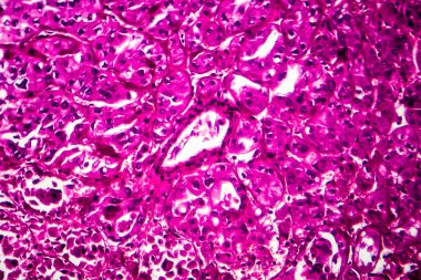 Böbrek kanseri, hafif mikrograf, mikroskop altında fotoğraf.