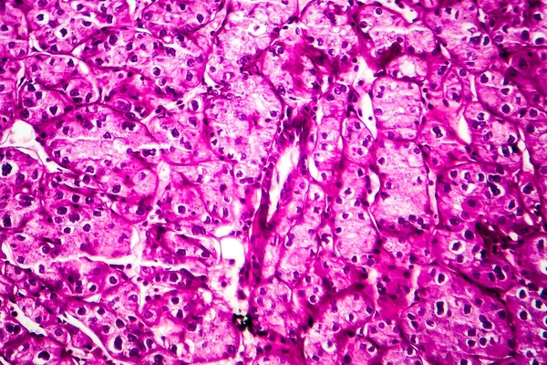 Nierenkrebs Lichtmikroskopie Foto Unter Dem Mikroskop — Stockfoto