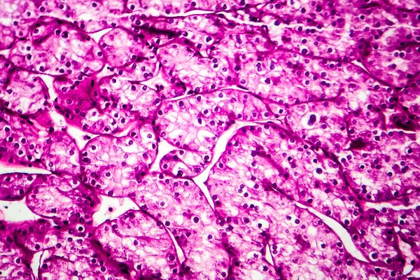 Rak Nerki Mikrograf Świetlny Zdjęcie Pod Mikroskopem — Zdjęcie stockowe