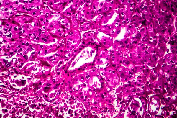 신장암 마이크로 그래프 현미경으로 — 스톡 사진