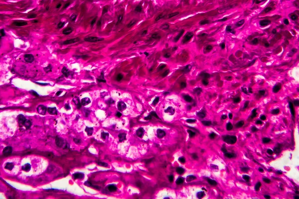 Rak Nerki Mikrograf Świetlny Zdjęcie Pod Mikroskopem — Zdjęcie stockowe