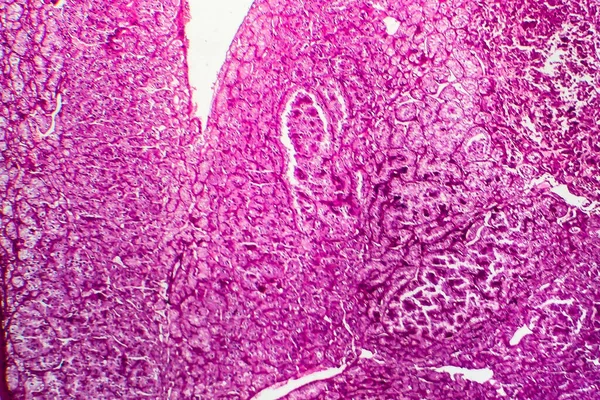Cancro Rim Micrografia Luz Foto Sob Microscópio — Fotografia de Stock