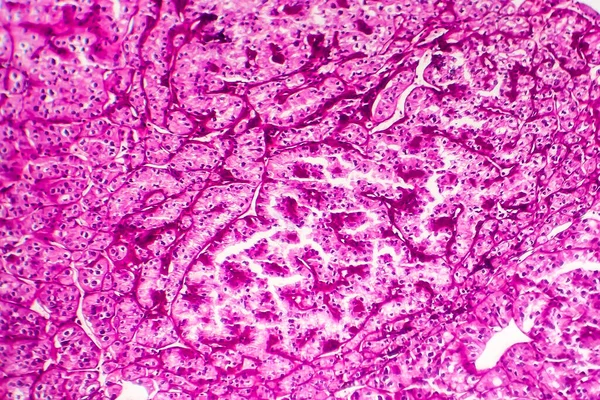 Kidney Cancer Light Micrograph Photo Microscope — Stock Photo, Image
