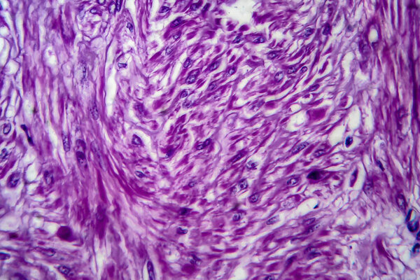 Uterine leiomyoma, also known as fibroids,a benign smooth muscle tumor of the uterus, light micrograph, photo under microscope