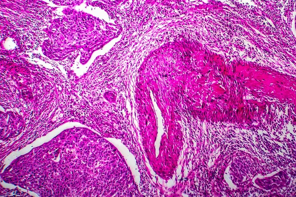 Spinocelulární Karcinom Dělohy Světelný Mikrograf Fotografie Pod Mikroskopem — Stock fotografie