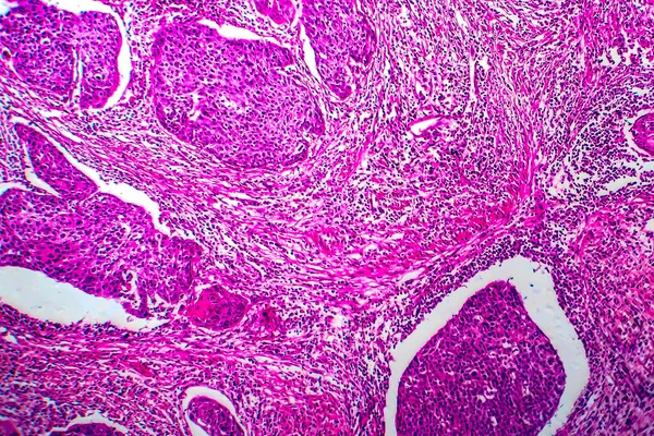 子宫鳞状细胞癌 光镜下摄影 — 图库照片