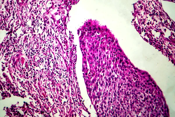 Rak Płaskonabłonkowy Macicy Mikrograf Świetlny Zdjęcie Pod Mikroskopem — Zdjęcie stockowe