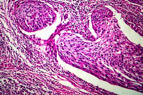 Carcinoma Espinocelular Útero Micrografia Luz Foto Sob Microscópio — Fotografia de Stock