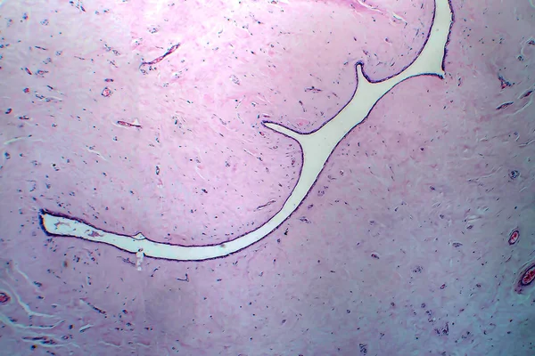 Adenofibroma Útero Micrografía Ligera Foto Bajo Microscopio Tumor Benigno Raro — Foto de Stock