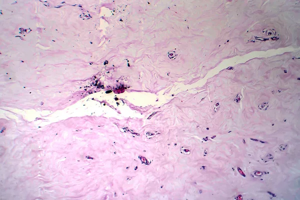 Uterus Adenofibroma Lichtmikroskopie Foto Unter Dem Mikroskop Seltener Gutartiger Tumor — Stockfoto