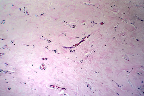 Adenofibroma Útero Micrografía Ligera Foto Bajo Microscopio Tumor Benigno Raro — Foto de Stock