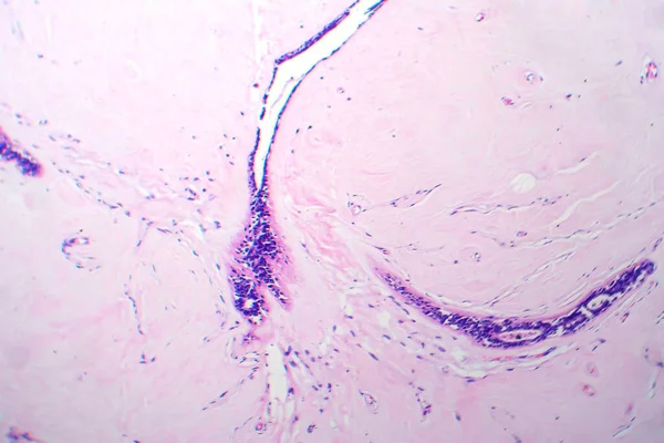 子宫腺纤维瘤 显微镜下照片 一种罕见的由腺体和纤维组织组成的良性子宫肿瘤 — 图库照片