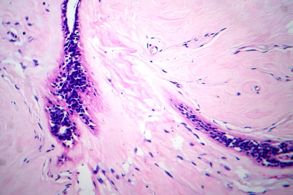 Adenofibroma Útero Micrografía Ligera Foto Bajo Microscopio Tumor Benigno Raro —  Fotos de Stock