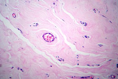 Uterus adenofibroma, light micrograph, photo under microscope. A rare benign tumor of the uterus composed of glandular and fibrous tissues clipart