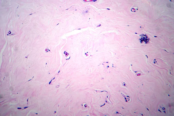 Adenofibroma Útero Micrografía Ligera Foto Bajo Microscopio Tumor Benigno Raro — Foto de Stock