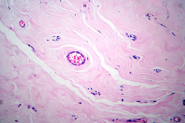 子宫腺纤维瘤 显微镜下照片 一种罕见的由腺体和纤维组织组成的良性子宫肿瘤 — 图库照片