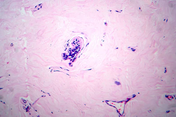 Uterus adenofibroma, light micrograph, photo under microscope. A rare benign tumor of the uterus composed of glandular and fibrous tissues