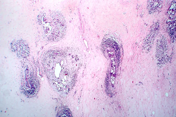 Breast Fibroadenosis Mikrograf Cahaya Foto Bawah Mikroskop Proses Hiperplastik Jinak — Stok Foto