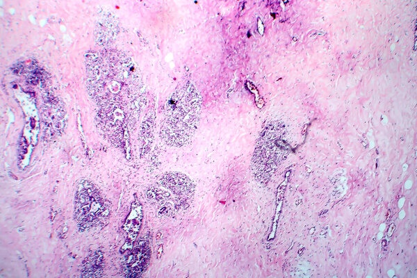Breast fibroadenosis, light micrograph, photo under microscope. Common benign hyperplastic process involving breast glands