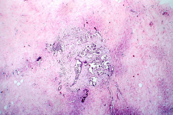 Fibroadenosis Peito Micrografia Luz Foto Sob Microscópio Processo Hiperplásico Benigno — Fotografia de Stock