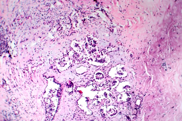 Fibroadénose Mammaire Micrographie Photonique Photo Microscope Processus Hyperplasique Bénin Fréquent — Photo