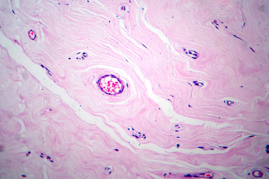 Uterus adenofibroma, light micrograph, photo under microscope. A rare benign tumor of the uterus composed of glandular and fibrous tissues