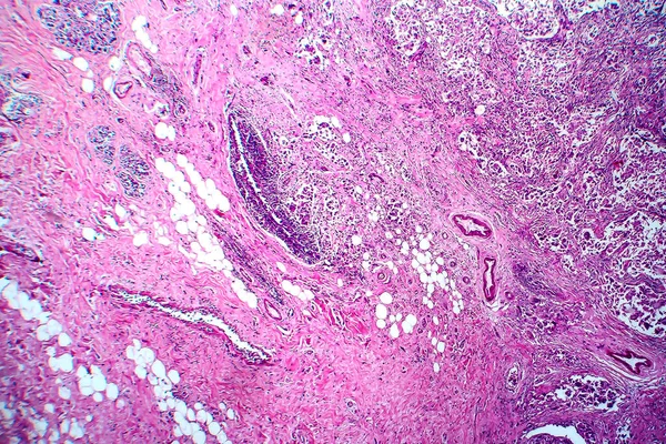 Carcinoma Ductal Mama Micrografia Luz Foto Sob Microscópio — Fotografia de Stock