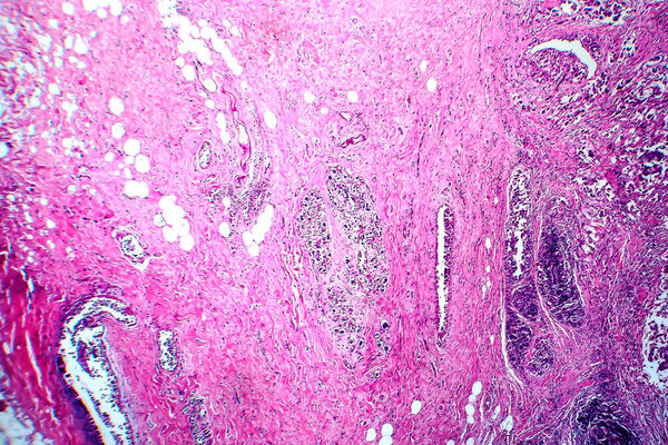 Breast ductal carcinoma, light micrograph, photo under microscope