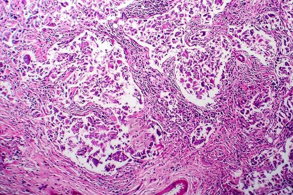 Carcinoma Duttale Mammario Microscopio Leggero Foto Microscopio — Foto Stock