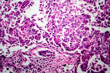 Göğüs kanseri, hafif mikrograf, mikroskop altında fotoğraf.