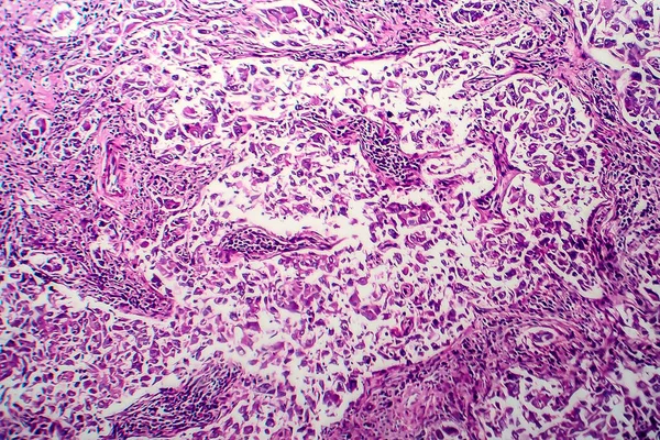 Bröstcancer Ljusmikrograf Foto Mikroskop — Stockfoto