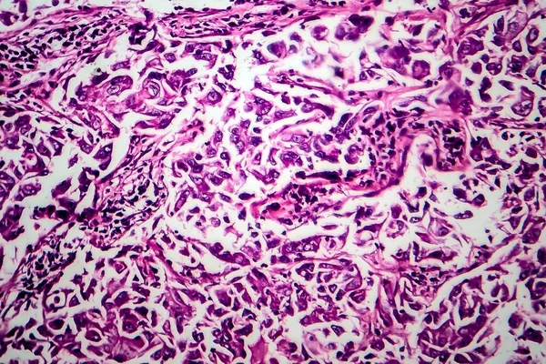 Emlőcsatorna Carcinoma Fénymikrográf Fénykép Mikroszkóp Alatt — Stock Fotó