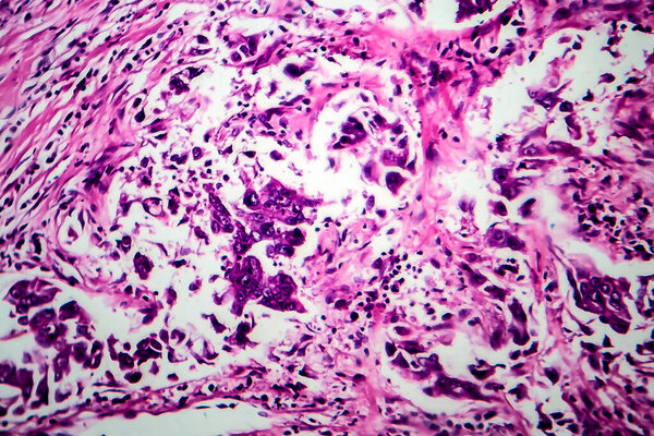 Breast ductal carcinoma, light micrograph, photo under microscope